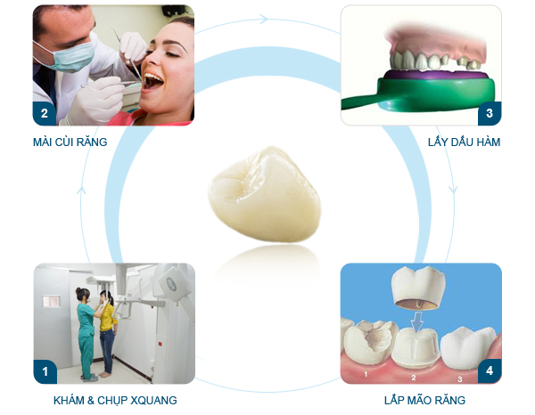 So Sánh Sự Thay Đổi Trước Sau Khi Bọc Sứ? – Nha Khoa Quốc Tế Á Châu - ảnh 3